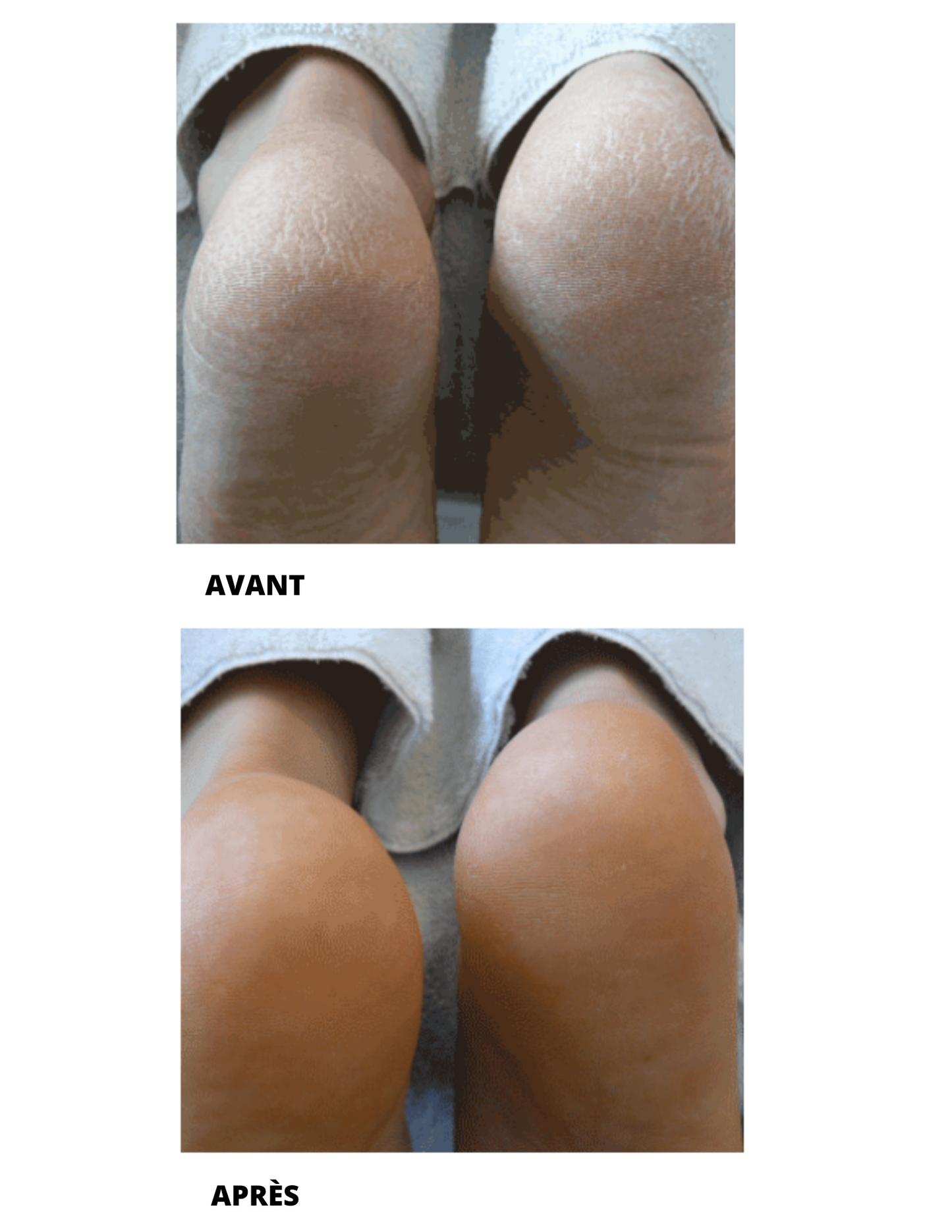 MOUSSE POUR PEAU TRÈS SÈCHE - FOOTLOGIX