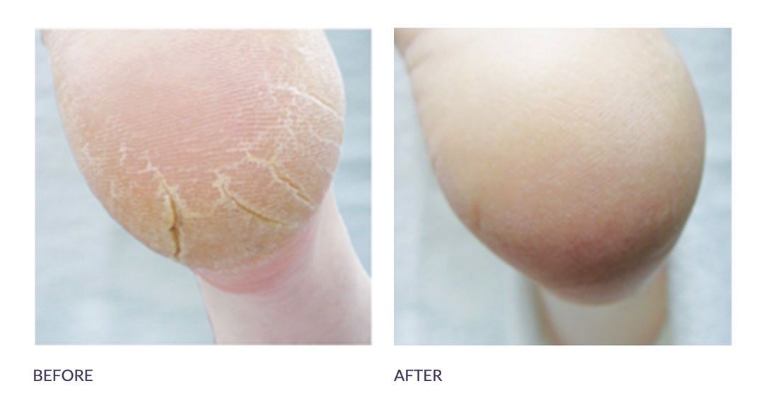 P-Footlogix - formule contre les gerçures et les crevasses / mousse