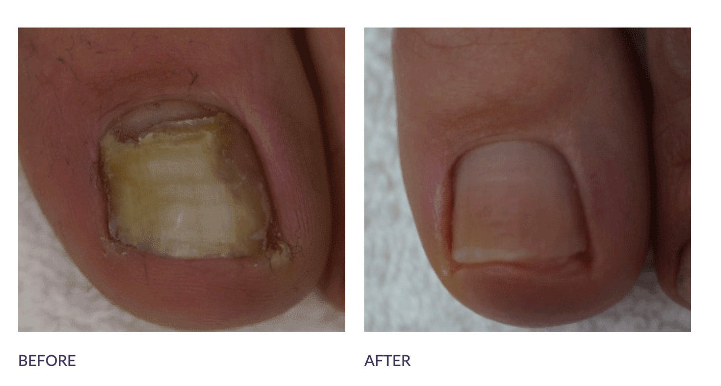 TEINTURE POUR LES ONGLES - FOOTLOGIX